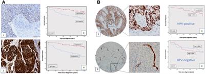 Fibroblasts from HPV-negative oropharynx squamous cell carcinomas stimulate the release of osteopontin from cancer cells via the release of IL-6